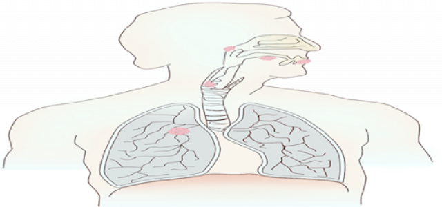 Replimune gives an update on RP1 Clinical Development Program in CSCC